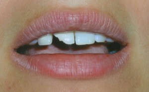 Pre Tooth Bonding | Cosmetic Dentistry Durham