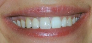 Post Teeth Bonding Procedure | Cosmetic Dentistry Durham