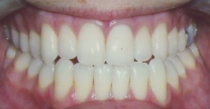Post Tooth Veneers | Cosmetic Dentistry Durham