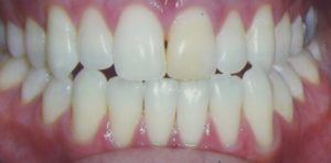 Pre Teeth Veneers | Cosmetic Dentistry Durham